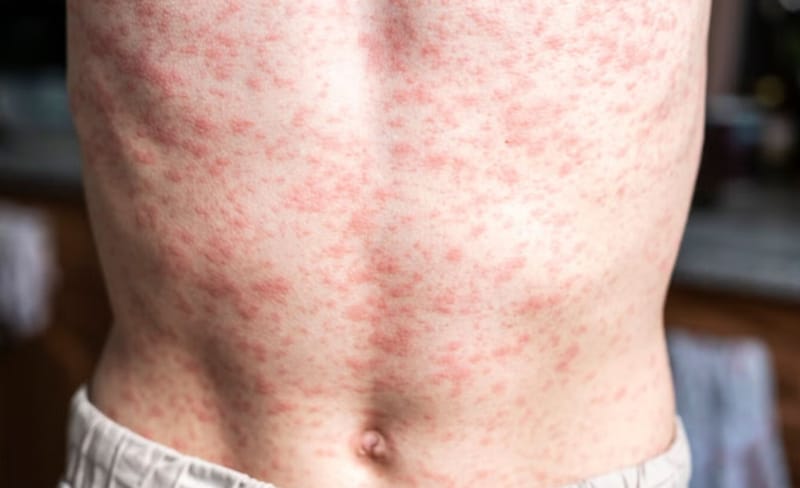 Alerta por caso importado de sarampión en ‘La Ciudad Bonita’ imagen de la publicación